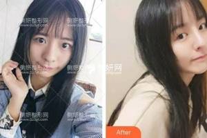 长沙亚韩医学美容医院赵贵庆假体隆鼻怎么样附最新价格表