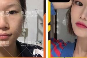 上海华美医疗美容医院胡小清假体隆鼻怎么样附最新价格表