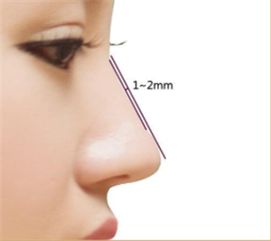 自体软骨组织隆鼻术有何优势