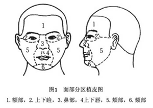 咬肌切除术安全吗