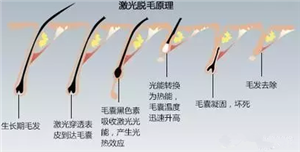 睫毛种植疼吗