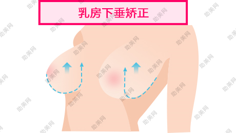 韩式巨乳缩小术后疤痕更细小吗