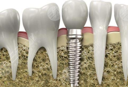 种植牙需要多长时间