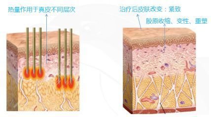 做热玛吉一次的费用是多少呢?