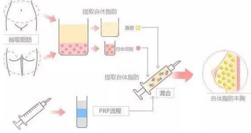 脂肪填充全脸手术