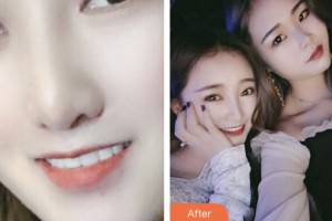 荆门市口腔医院刘明海整形价格表附牙贴面案例展示