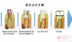 根管治疗后，牙齿还能用多久？