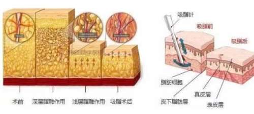 面部吸脂和去颊脂垫哪个好？两种手术的区别是什么？适合人群有哪些？