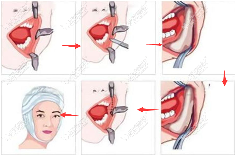 下颌角手术切口在哪儿——内切口 下颌角手术切口在哪儿——内切口