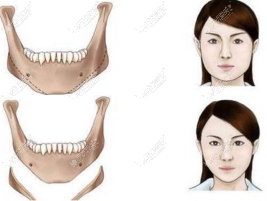 下颌角手术风险大吗?——风险不大 下颌角手术风险大吗?——风险不大