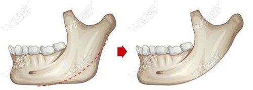 赵贵庆医生下颌角手术原理 赵贵庆医生下颌角手术原理