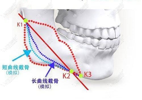 赵贵庆下颌角截骨技术 赵贵庆下颌角截骨技术