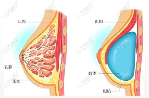 林沸腾做假体隆胸不硬，技术好