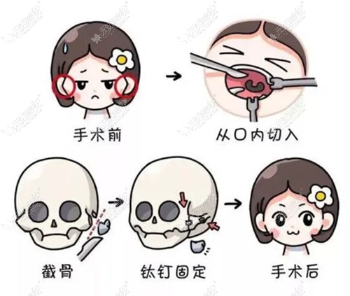 重庆肖林做颧骨内推怎么样 重庆肖林做颧骨内推怎么样