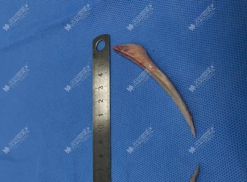 肖林医生做下颌角手术怎么样 肖林医生做下颌角手术怎么样