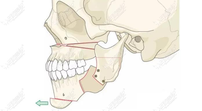 南宁正颌手术多少钱 南宁正颌手术多少钱