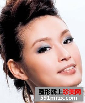 玻尿酸注射隆鼻