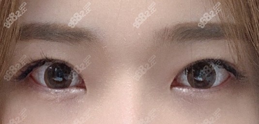 韩国TS整形外科眼修复术后一年效果