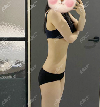 水动力吸脂术后3个月正面效果图 水动力吸脂术后3个月正面效果图