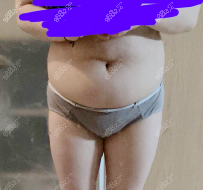 吸脂术前正面腰腹部照片 吸脂术前正面腰腹部照片