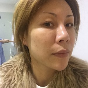 在深圳做了4次激光祛斑的恢复效果,真的干净了