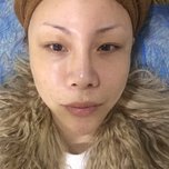 在深圳做了4次激光祛斑的恢复效果,真的干净了