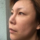 在深圳做了4次激光祛斑的恢复效果,真的干净了