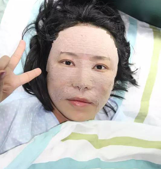 自体脂肪面部填充怎样,案例分享!