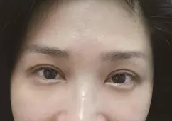 术后图片 术后图片