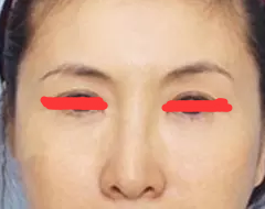 术后图片 术后图片