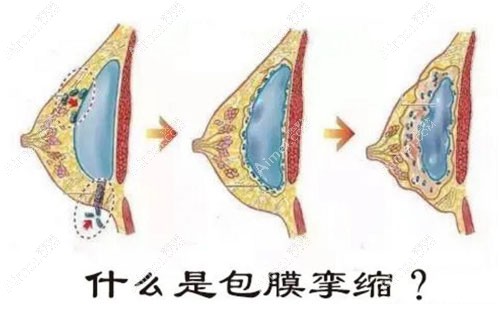 假体隆胸手术包膜挛缩几率大吗？这种症状按摩能改善吗？