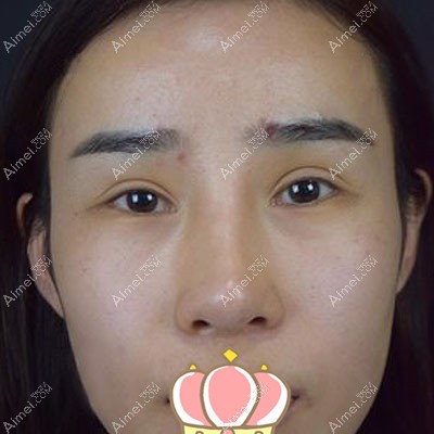 双眼皮术后有凹陷疤痕找广东韩妃李光琴做修复效果图反馈