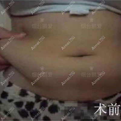 腰腹环吸3个月复盘：抽脂1300ml小肚子平坦瘦4cm,烟台鹏爱靠谱