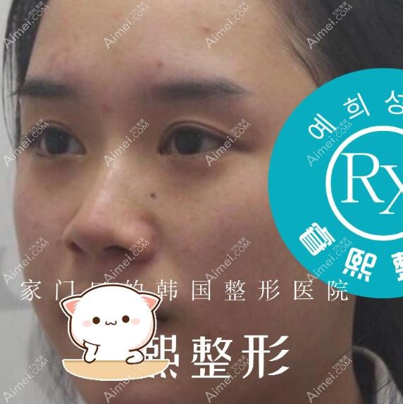 在连云港睿熙做肋软骨隆鼻和鼻综合的人发来整鼻子效果图