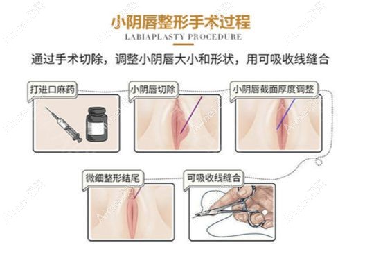 张蔚萱医生做小阴唇缩小的手术方法.jpg