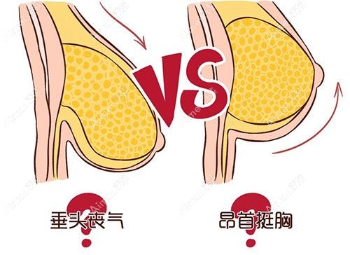 乳房下垂做人工韧带提升好还是双环悬吊好,区别和优势来了