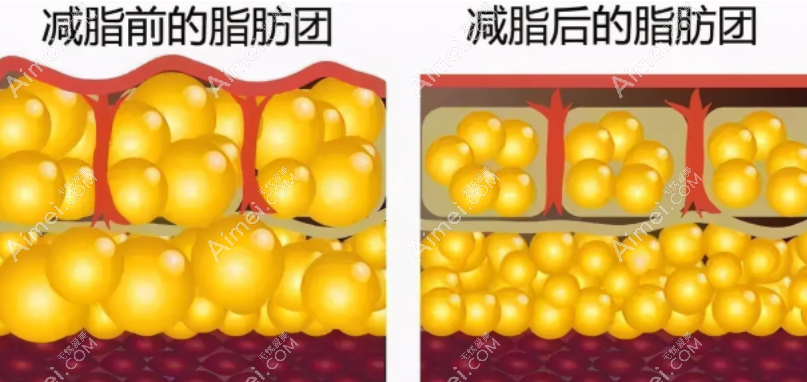 冯斌医生吸脂技术靠谱