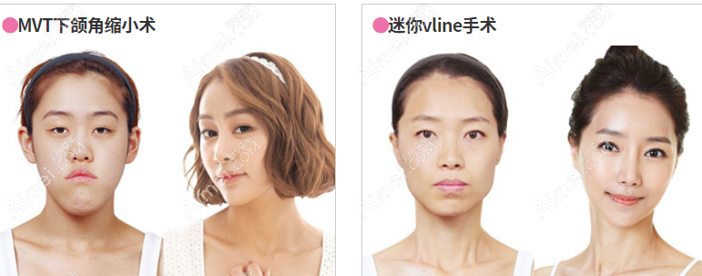 韩国id整形轮廓改脸型前后对比图
