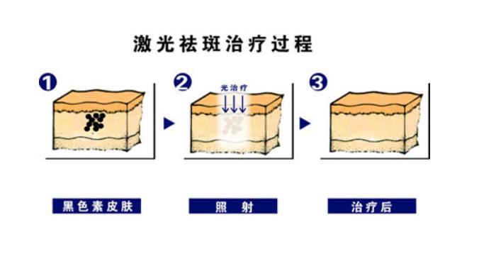 激光祛斑2.jpg