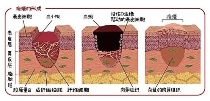 疤痕修复h.jpg