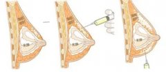 自体脂肪隆胸术后会缩水
