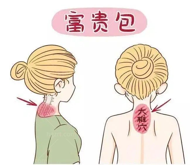 国内治疗富贵包的专科医院哪个好 国内治疗富贵包的专科医院哪个好