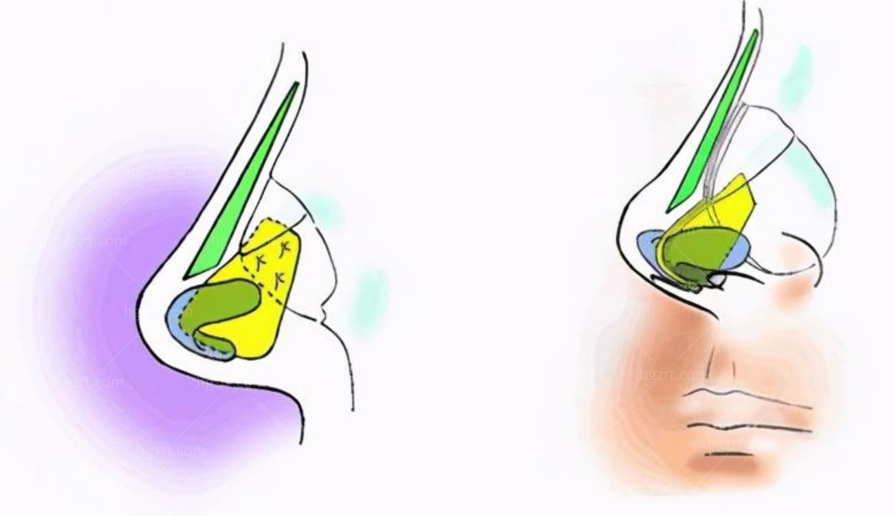 韩国隆鼻整形术.jpg 韩国隆鼻整形术.jpg