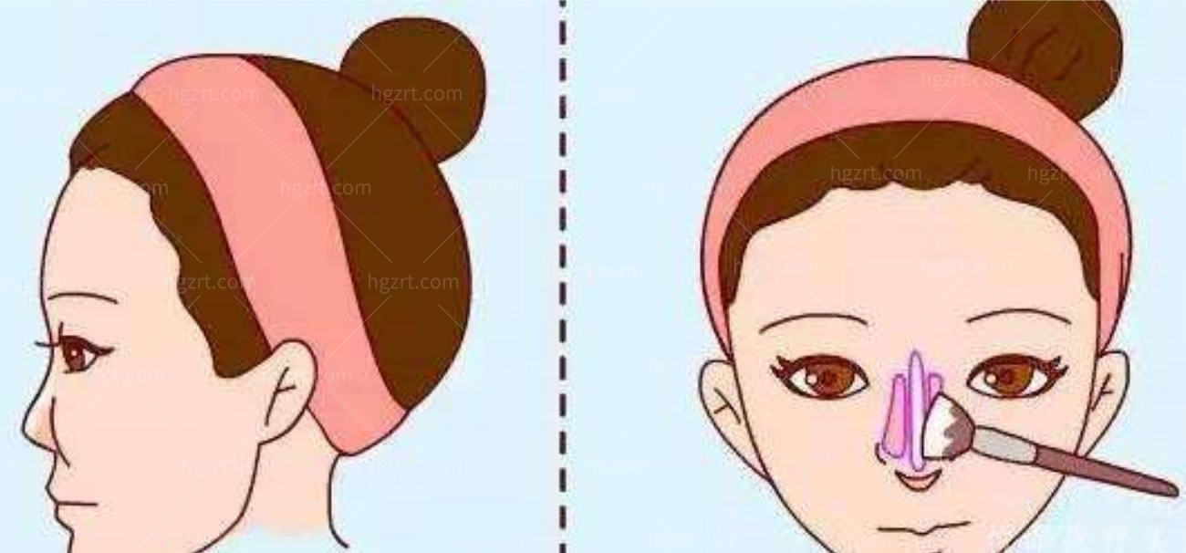 韩国隆鼻整形术.jpg 韩国隆鼻整形术.jpg