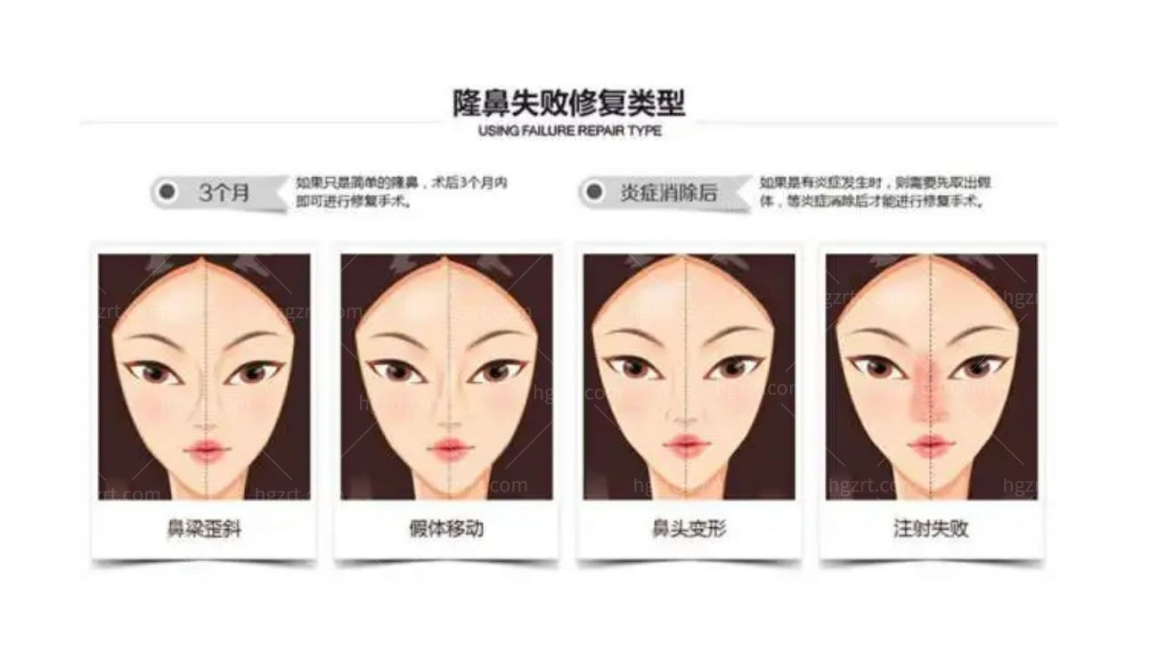 鼻修复.jpg 鼻修复.jpg