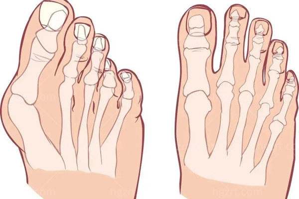 2023大脚骨手术收费标准一览表 2023大脚骨手术收费标准一览表