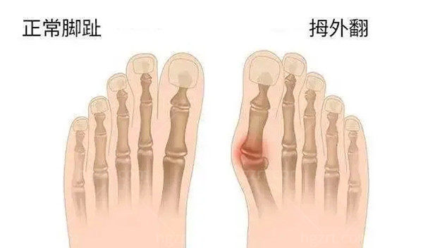 2023大脚骨手术收费标准一览表 2023大脚骨手术收费标准一览表