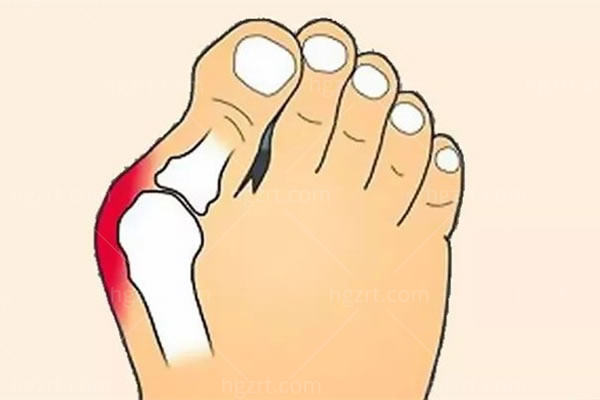 大脚骨手术 大脚骨手术