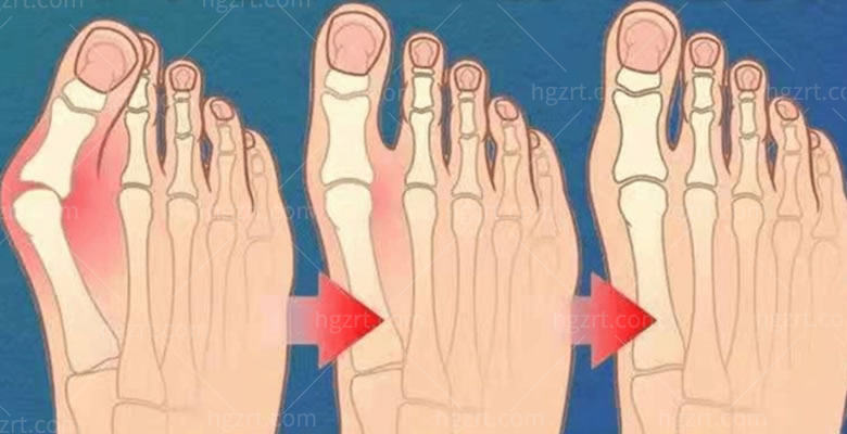 拇外翻矫正 拇外翻矫正