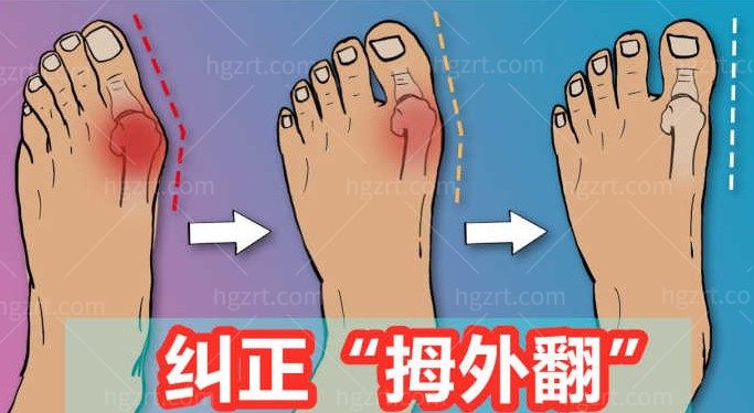 拇外翻矫正图 拇外翻矫正图